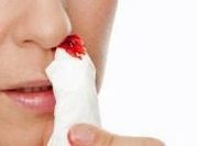 Nasenbluten Behandlung erste Hilfe