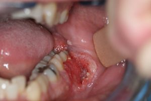 Krebs der Mundhöhle