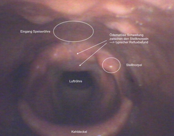 typischer endoskopischer Befund des Kehlkopfes bei Reflux