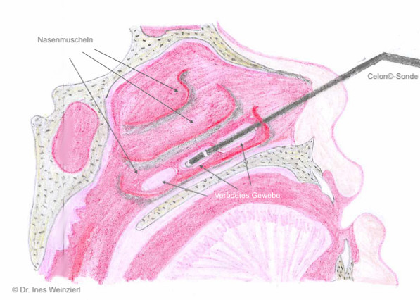 Therapieprinzipe der Nasenmuschelverödung mit Radiofrequenz, schematische Darstellung