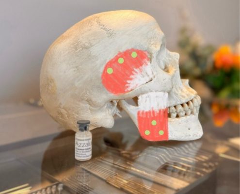 Botox gegen Zähneknirschen Injektionspunkte