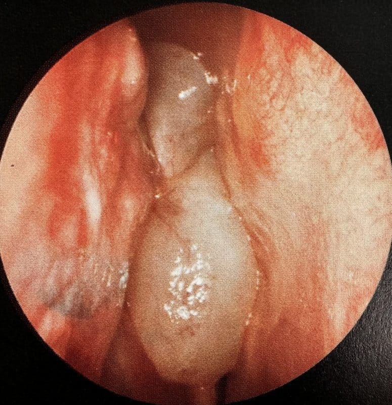 Nasenpolypen vor Antikörpertherapie